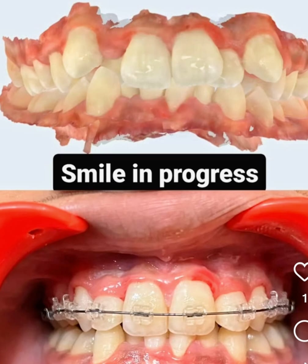 Before and after smile transformation